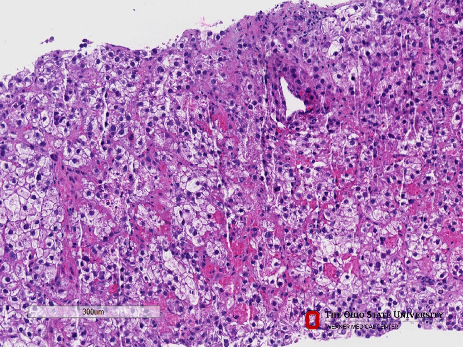 Microscopic image possibly detecting cancerous areas in human tissue