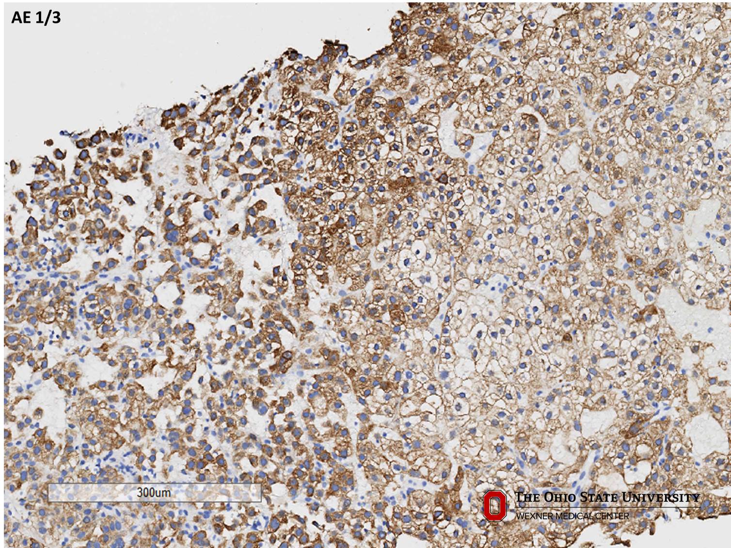 Microscopic image possibly detecting cancerous areas in human tissue