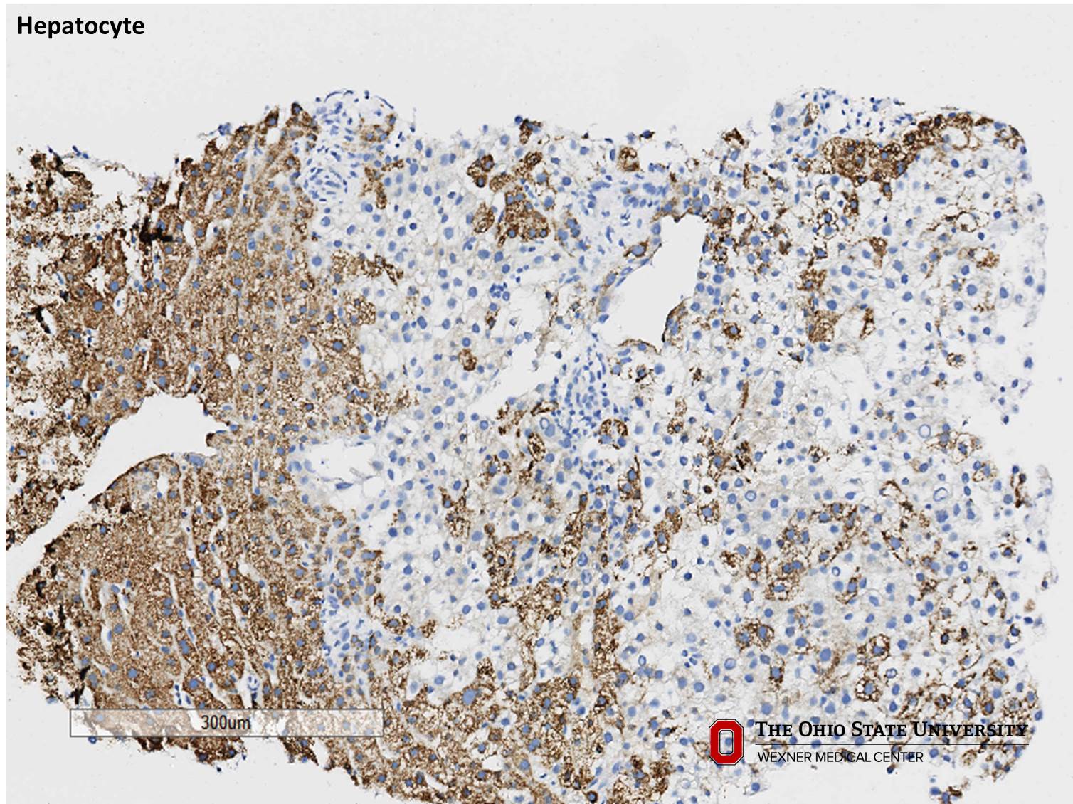 Microscopic image possibly detecting cancerous areas in human tissue