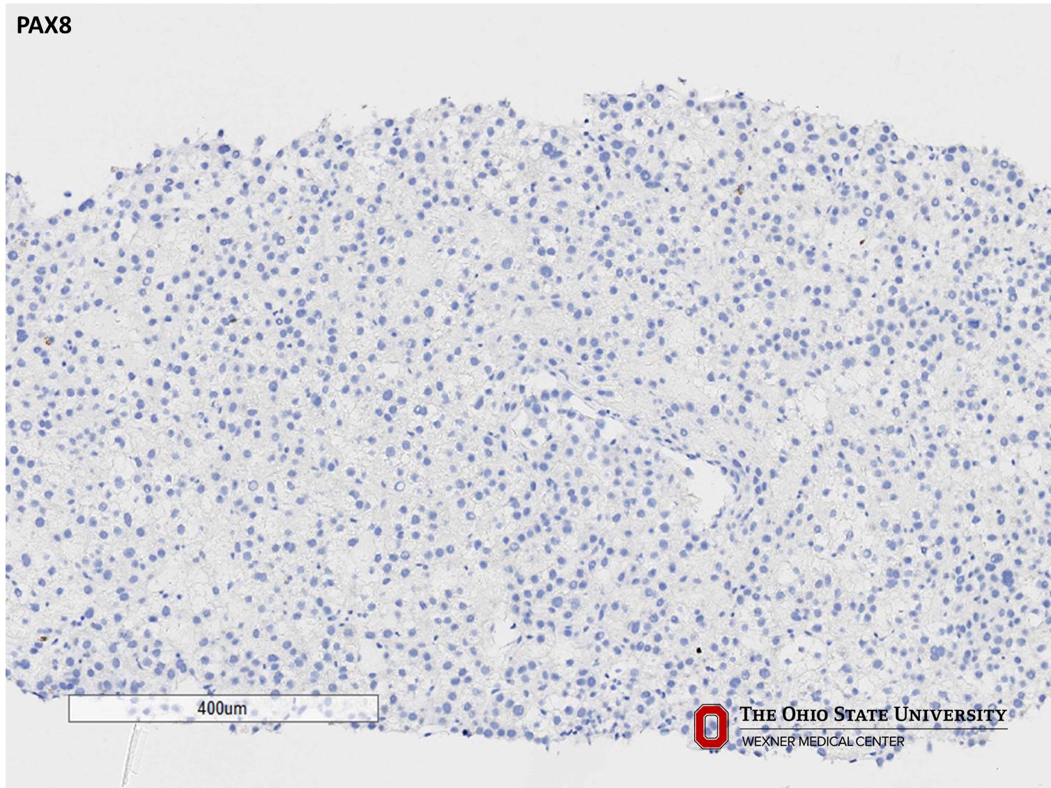 Microscopic image possibly detecting cancerous areas in human tissue