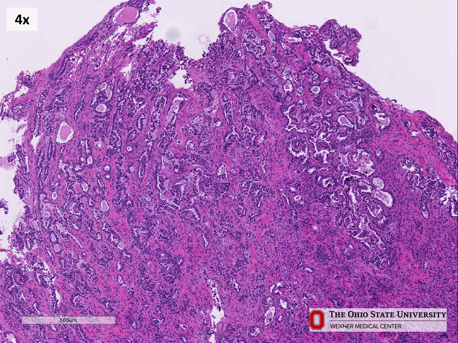 Microscopic image possibly detecting cancerous areas in human tissue