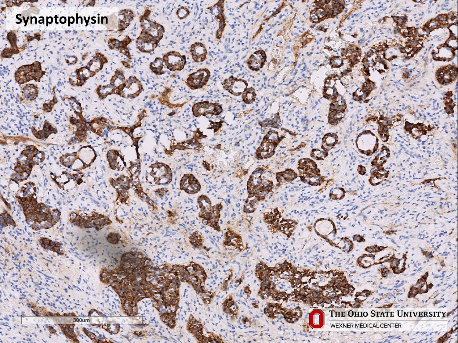 Microscopic image possibly detecting cancerous areas in human tissue