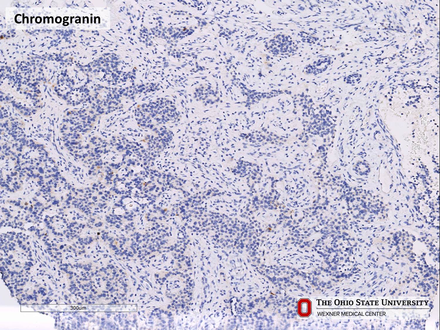 Microscopic image possibly detecting cancerous areas in human tissue