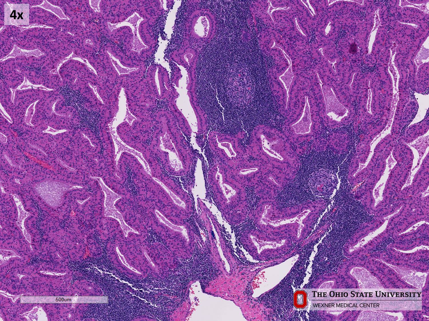 Microscopic image possibly detecting cancerous areas in human tissue