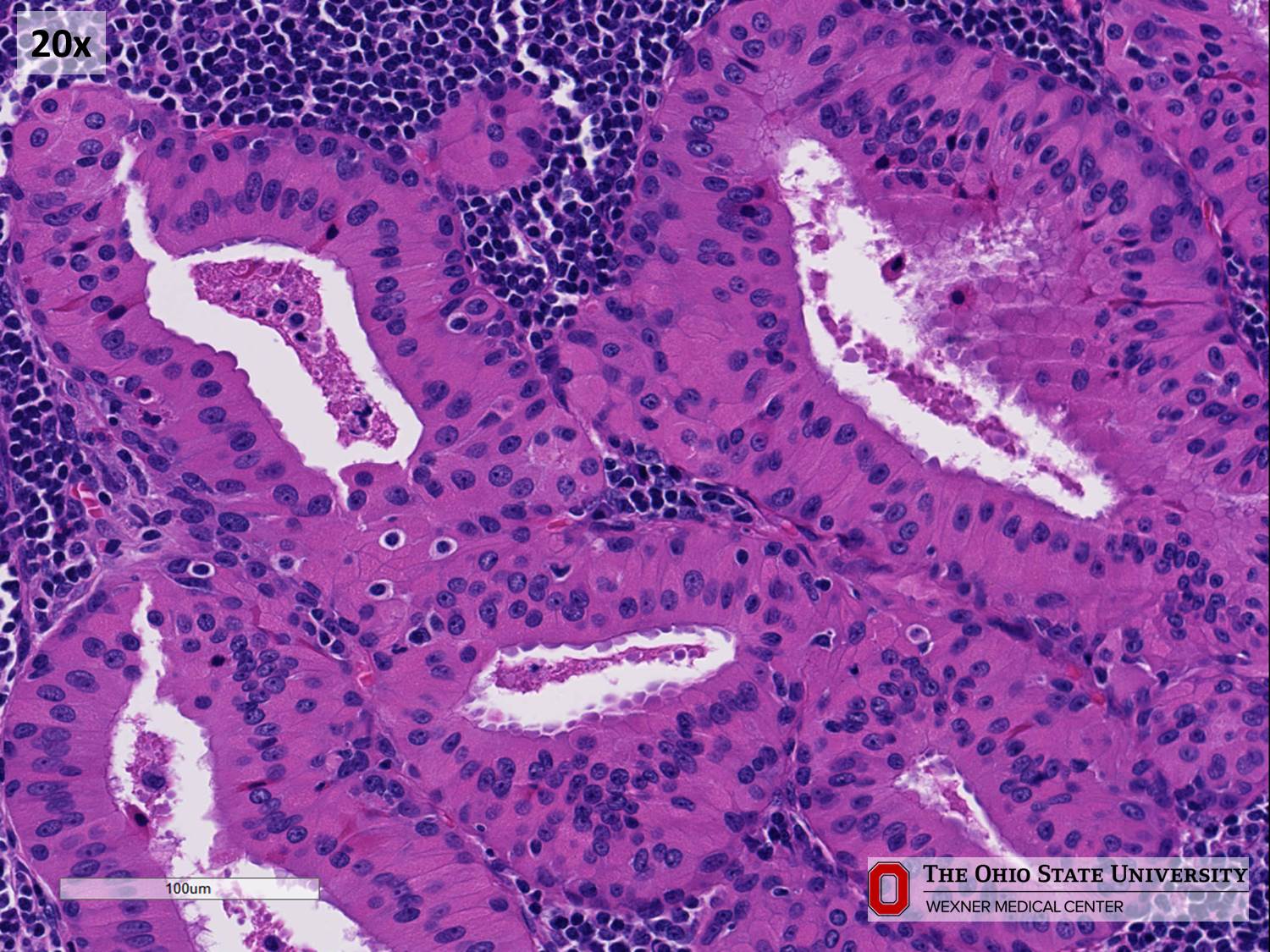 Microscopic image possibly detecting cancerous areas in human tissue