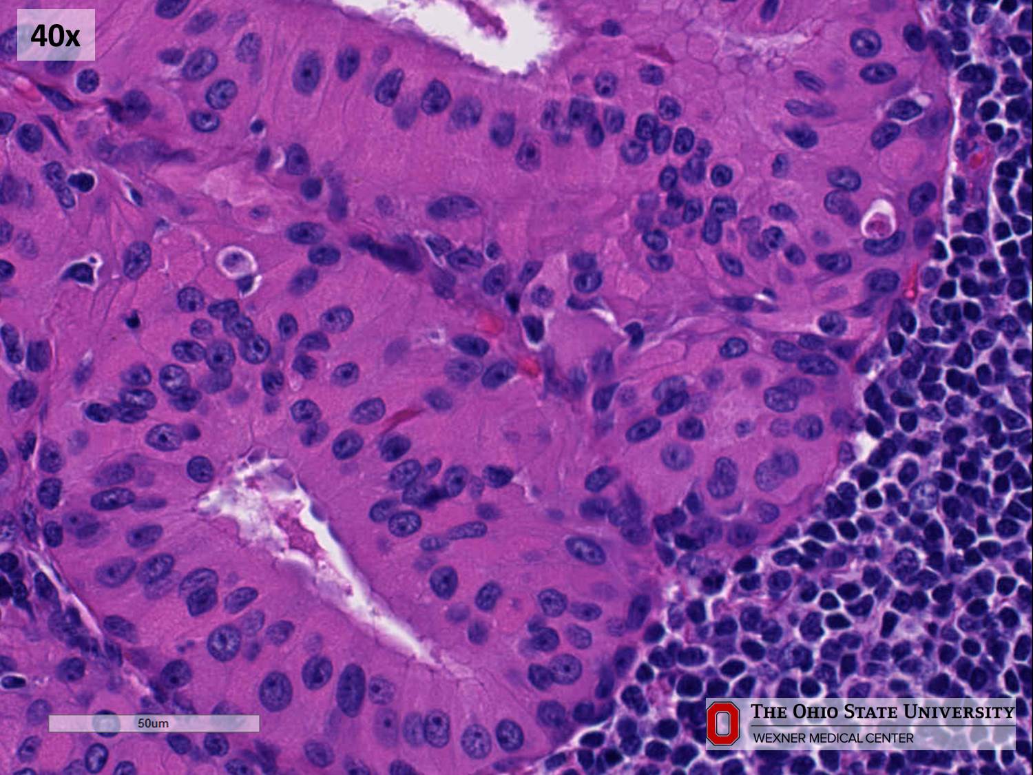 Microscopic image possibly detecting cancerous areas in human tissue