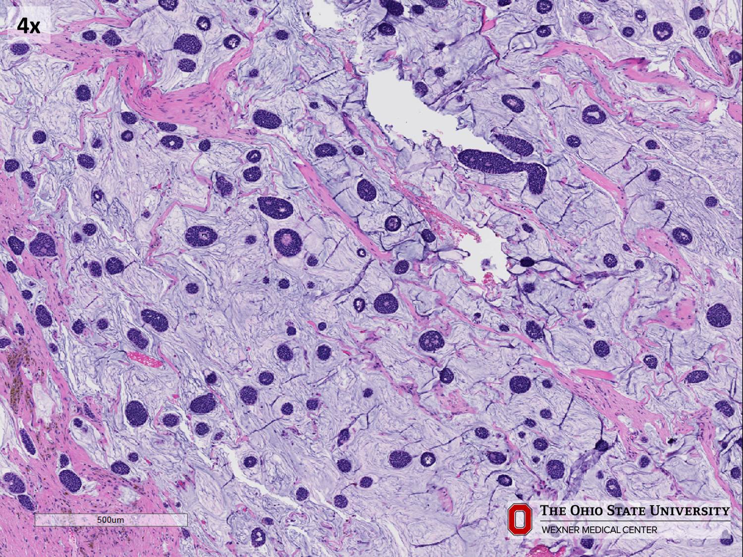 Microscopic image possibly detecting cancerous areas in human tissue