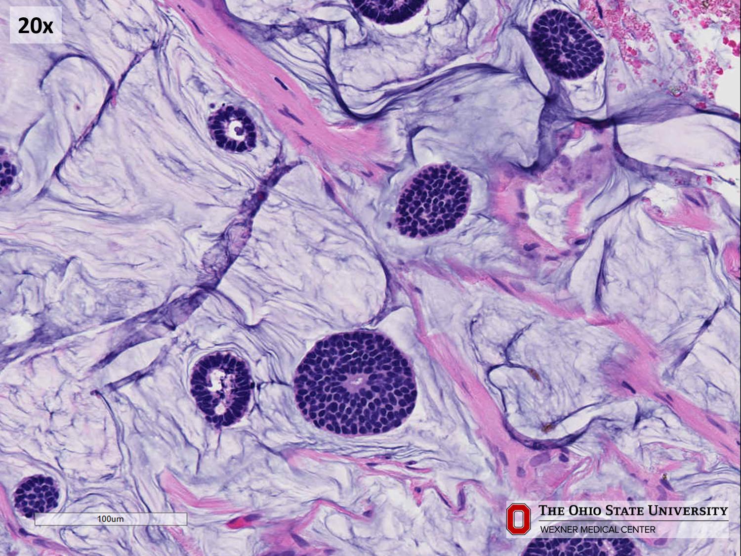 Microscopic image possibly detecting cancerous areas in human tissue