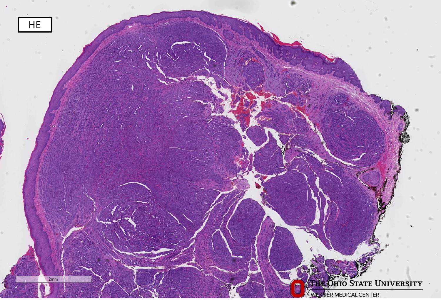 Microscopic image possibly detecting cancerous areas in human tissue