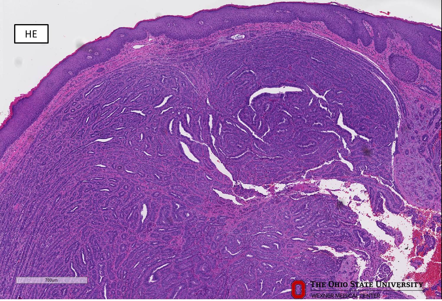 Microscopic image possibly detecting cancerous areas in human tissue