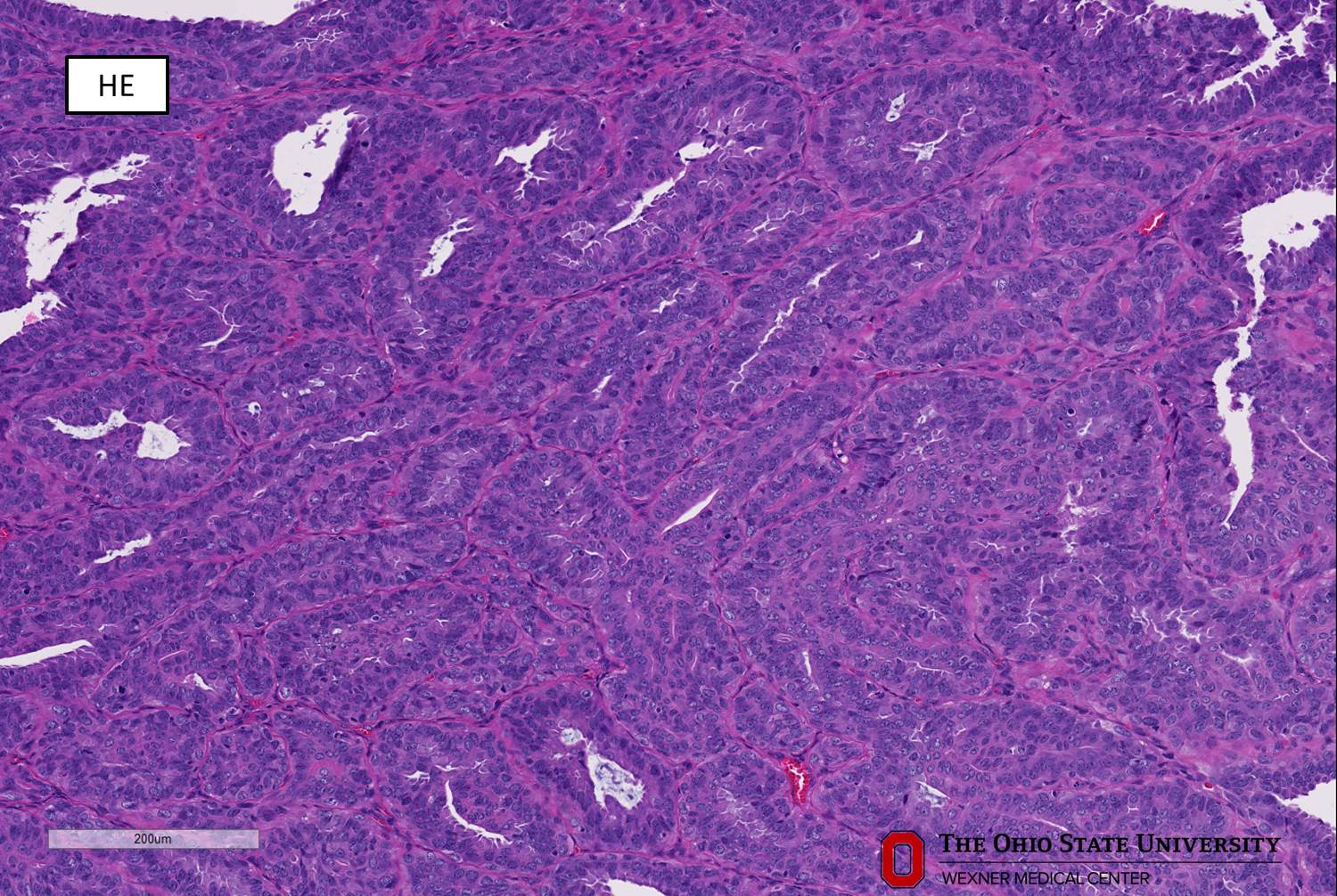 Microscopic image possibly detecting cancerous areas in human tissue