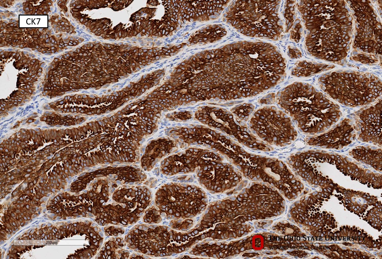 Microscopic image possibly detecting cancerous areas in human tissue