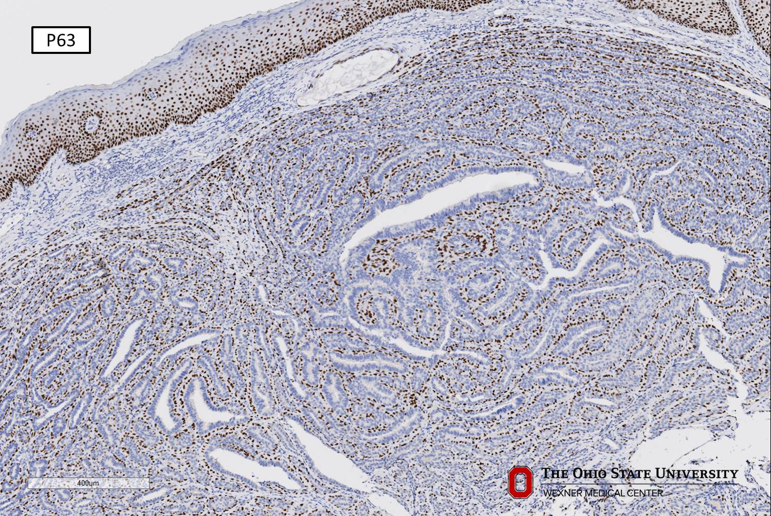 Microscopic image possibly detecting cancerous areas in human tissue