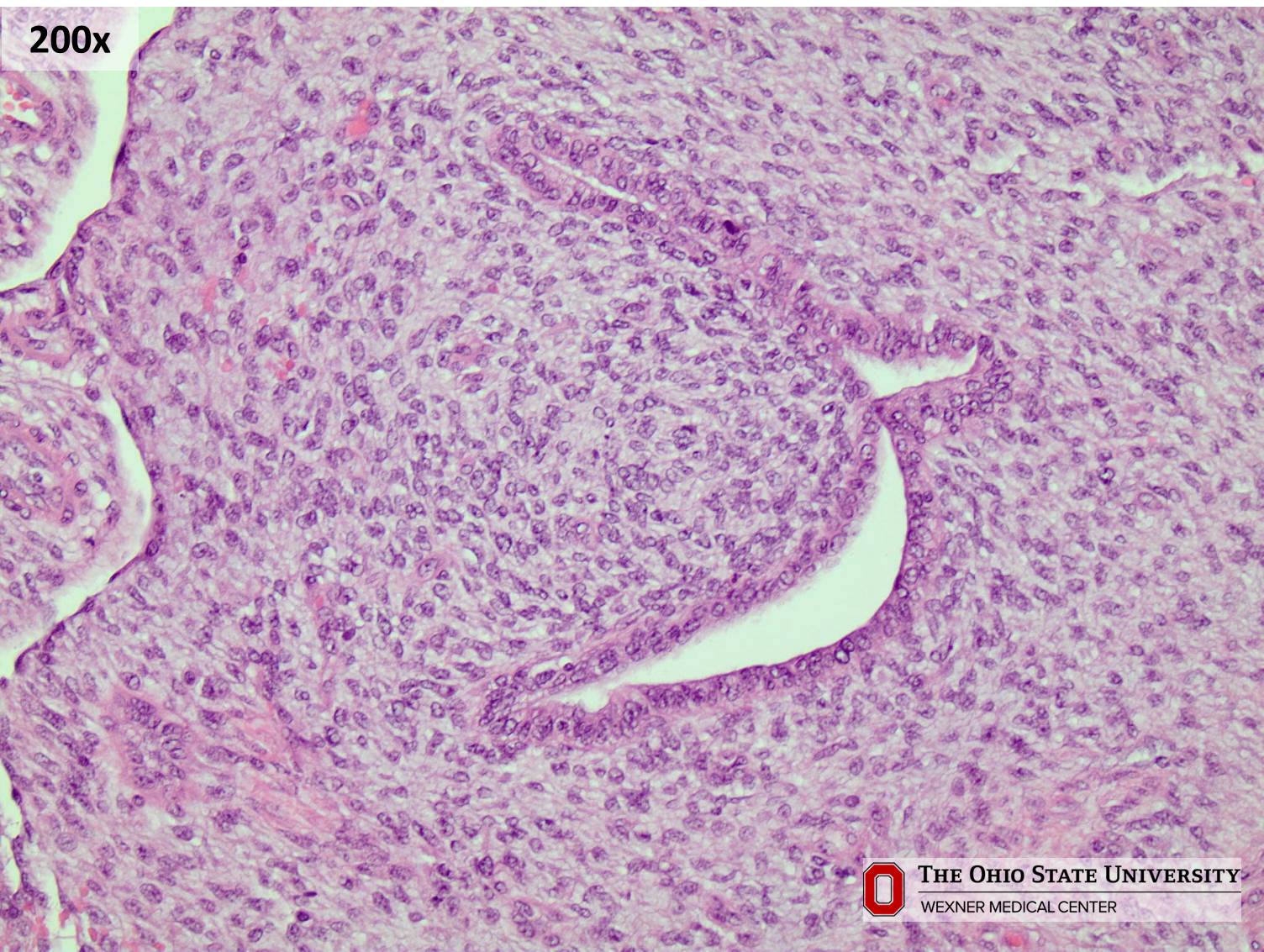 Microscopic image possibly detecting cancerous areas in human tissue