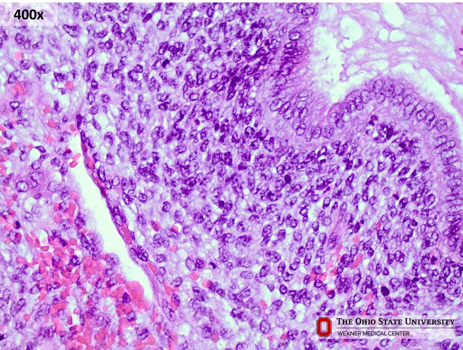 Microscopic image possibly detecting cancerous areas in human tissue