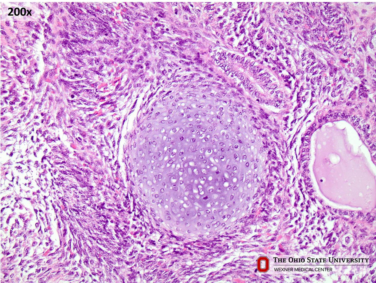 Microscopic image possibly detecting cancerous areas in human tissue