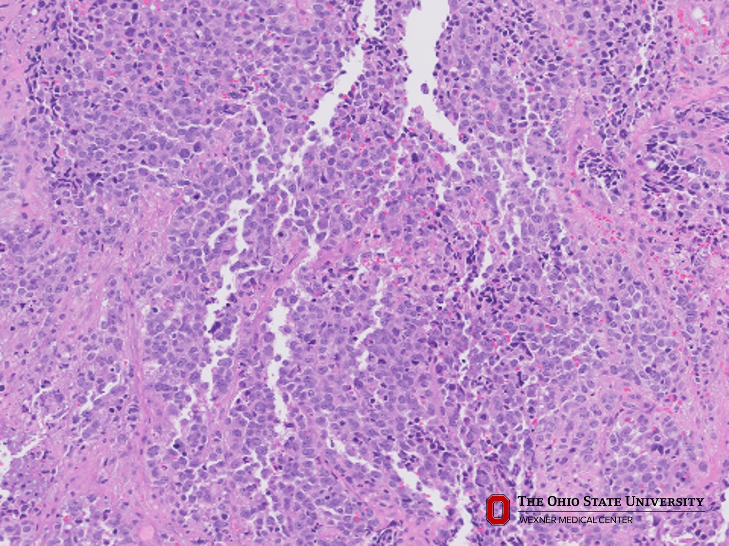 Microscopic image possibly detecting cancerous areas in human tissue