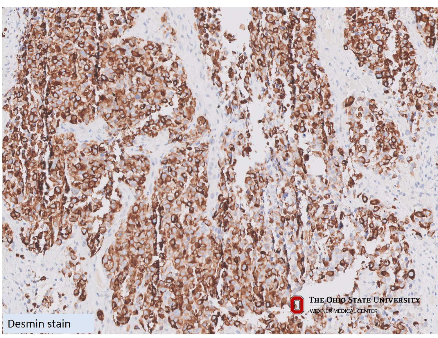 Microscopic image possibly detecting cancerous areas in human tissue