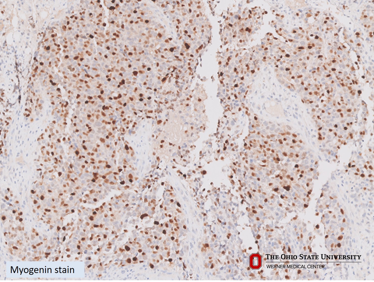 Microscopic image possibly detecting cancerous areas in human tissue