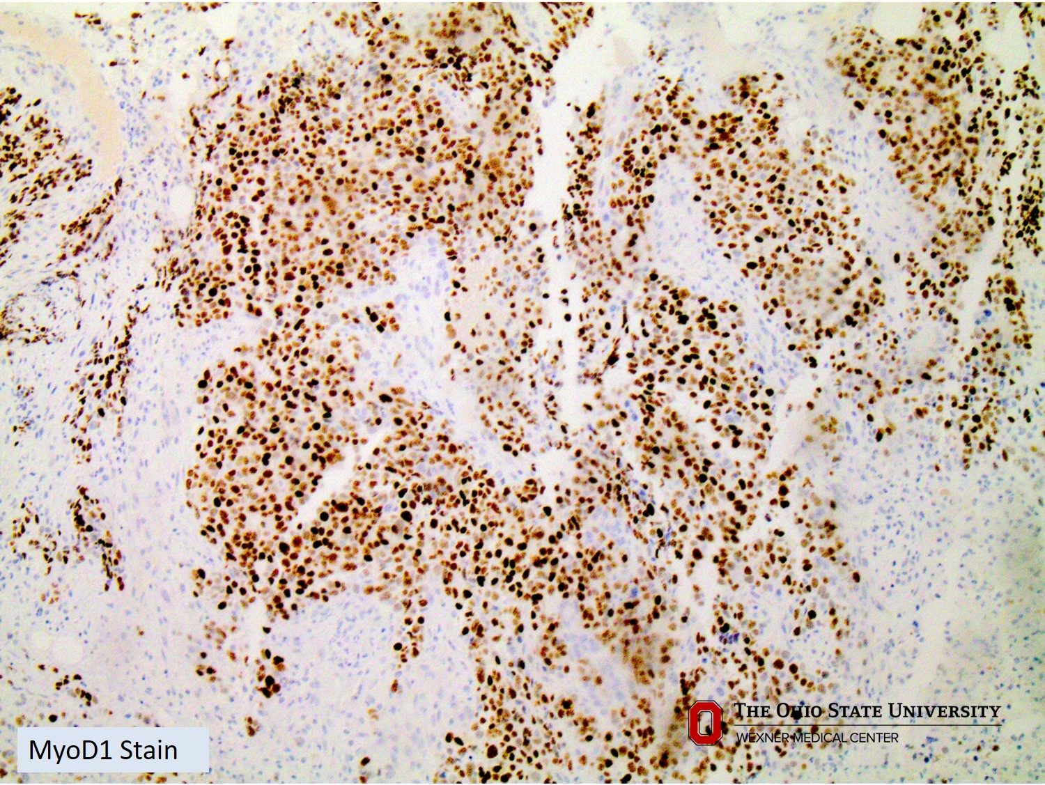 Microscopic image possibly detecting cancerous areas in human tissue