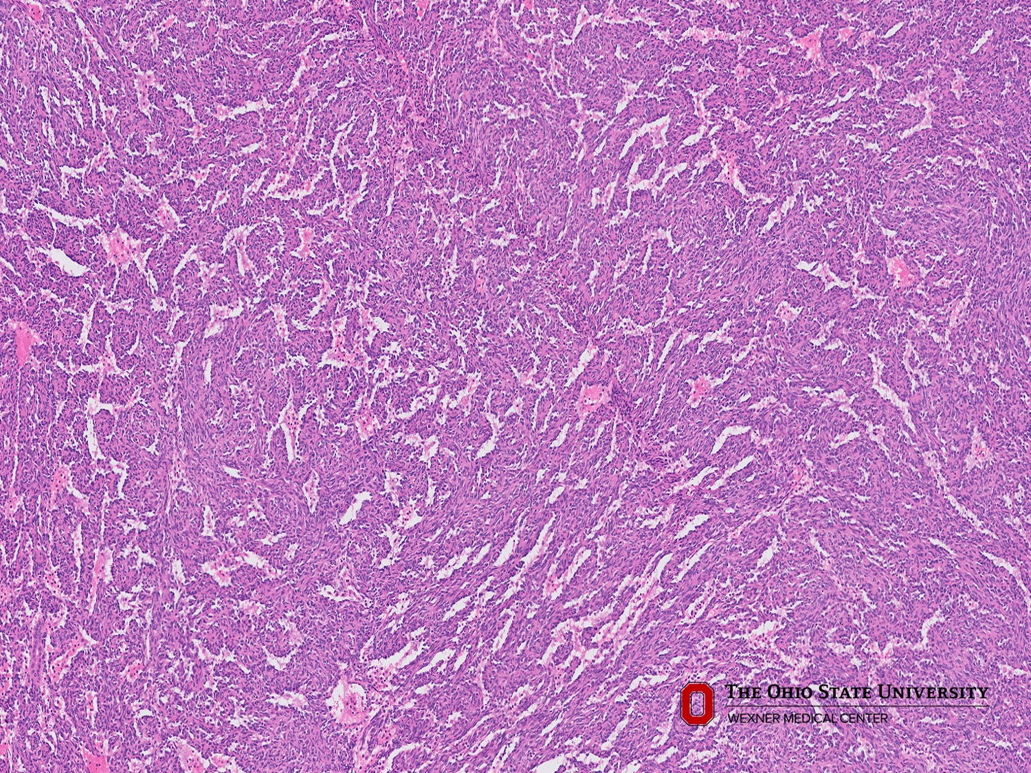 Microscopic image possibly detecting cancerous areas in human tissue