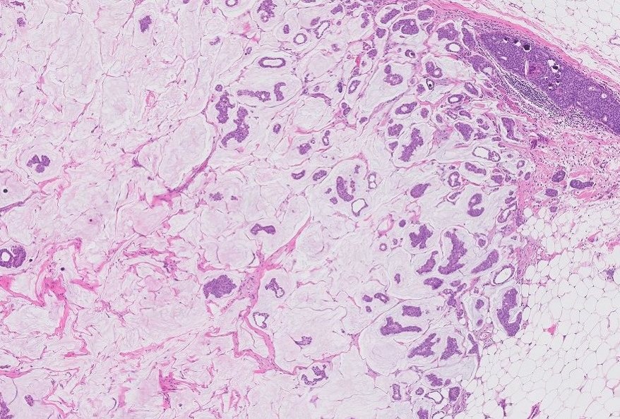 Microscopic image possibly detecting cancerous areas in human tissue