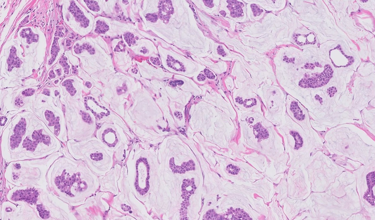 Microscopic image possibly detecting cancerous areas in human tissue