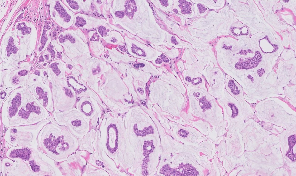 Microscopic image possibly detecting cancerous areas in human tissue