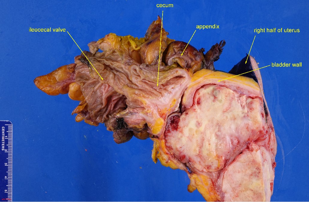 Gross image of bladder