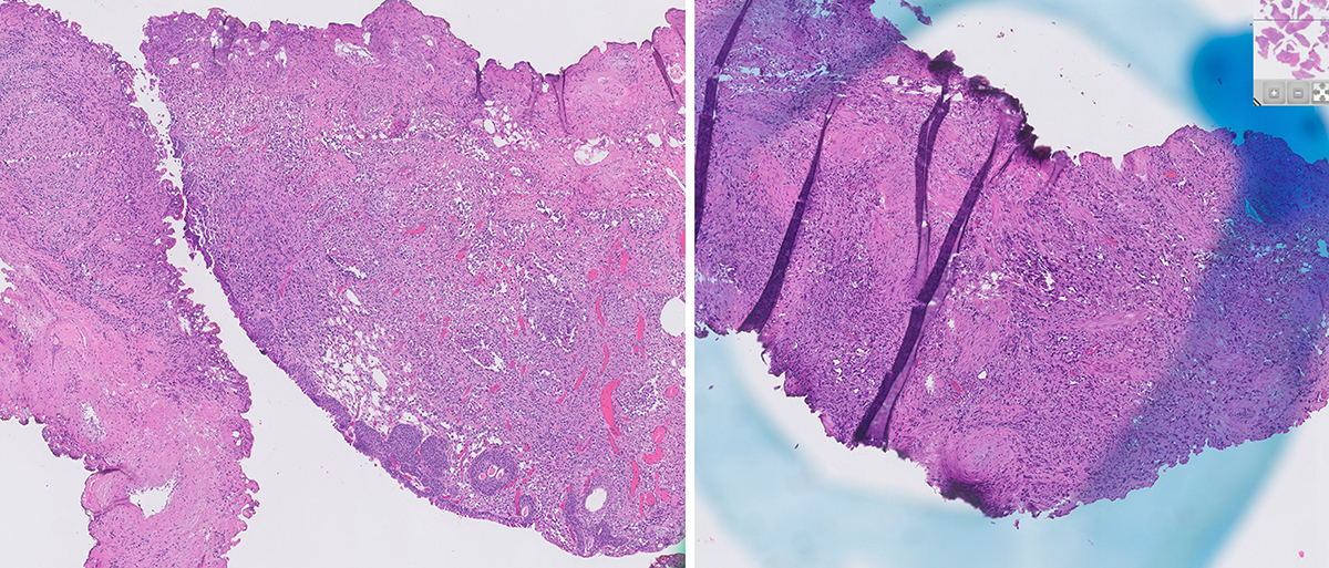 Microscopic image possibly detecting cancerous areas in human tissue