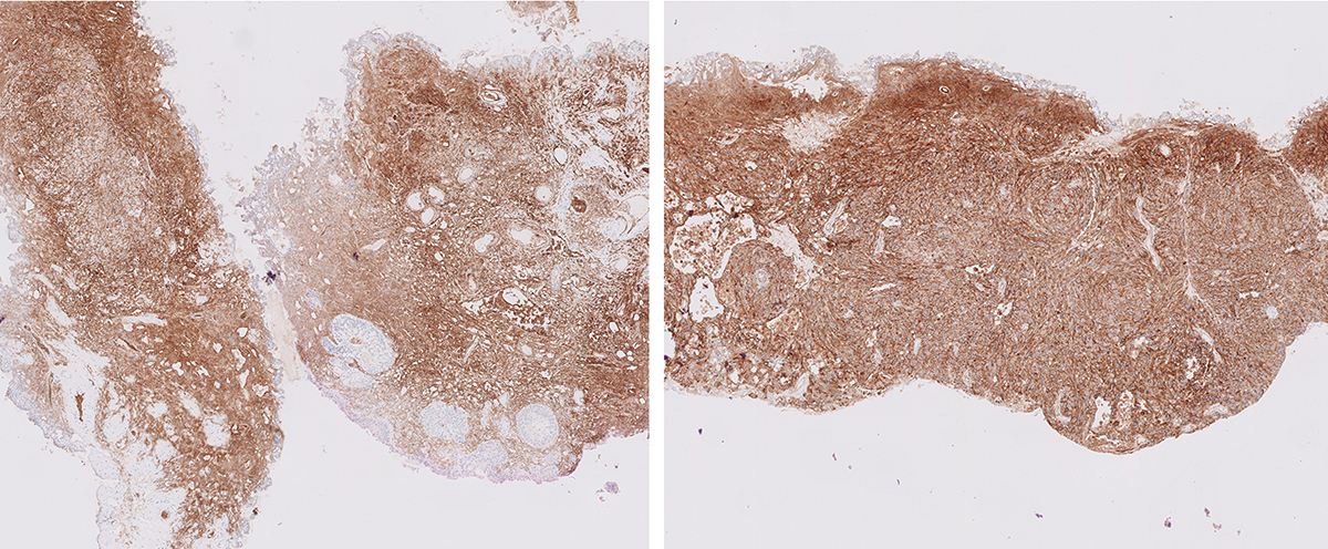 Microscopic image possibly detecting cancerous areas in human tissue