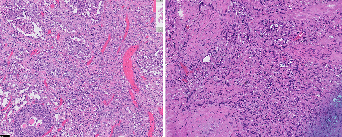 Microscopic image possibly detecting cancerous areas in human tissue