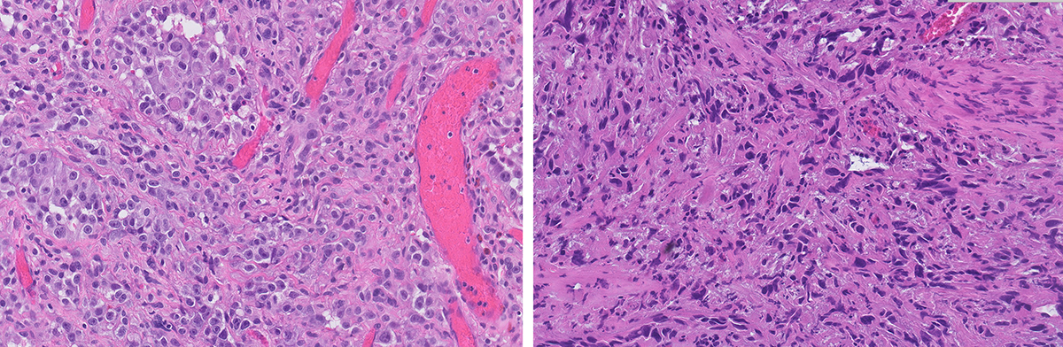 Microscopic image possibly detecting cancerous areas in human tissue