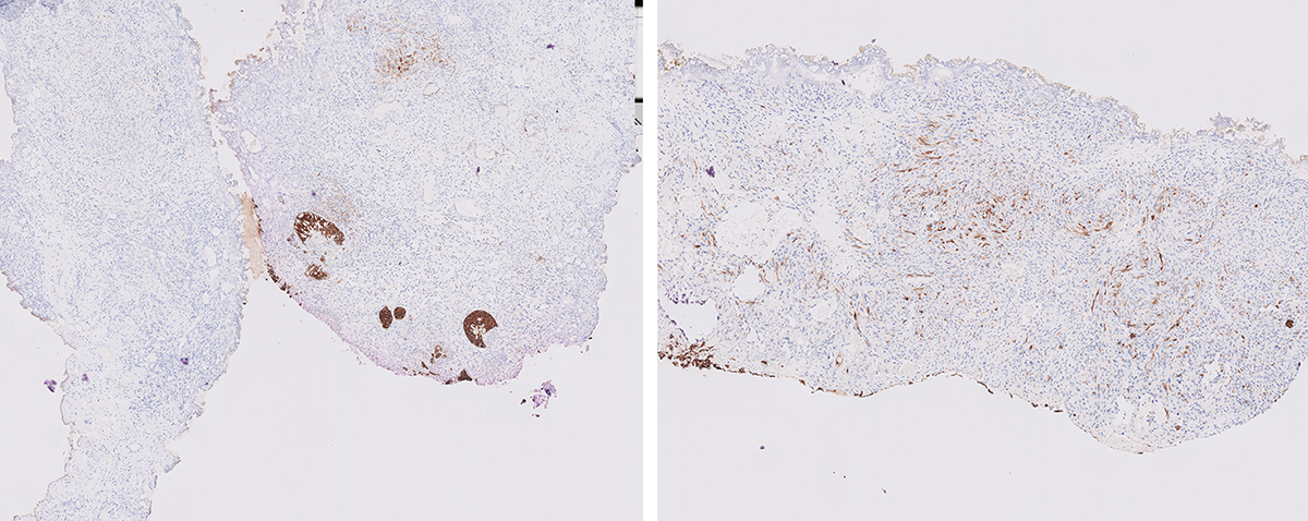 Microscopic image possibly detecting cancerous areas in human tissue