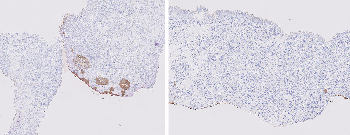 Microscopic image possibly detecting cancerous areas in human tissue