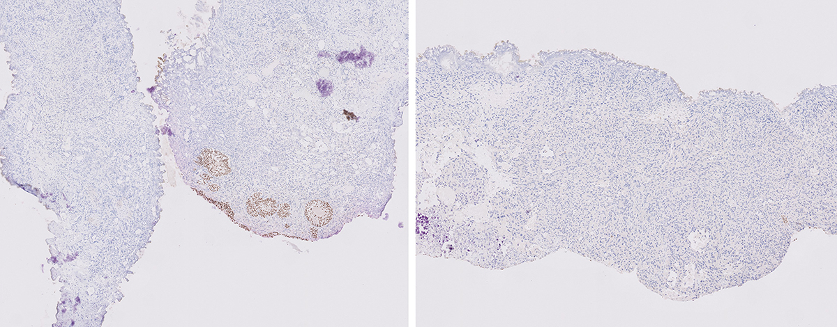 Microscopic image possibly detecting cancerous areas in human tissue