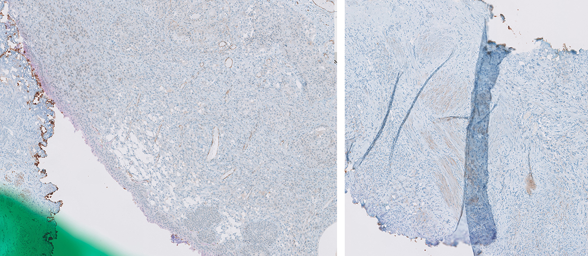 Microscopic image possibly detecting cancerous areas in human tissue