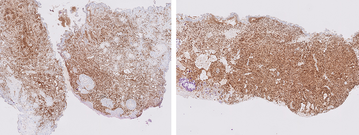 Microscopic image possibly detecting cancerous areas in human tissue