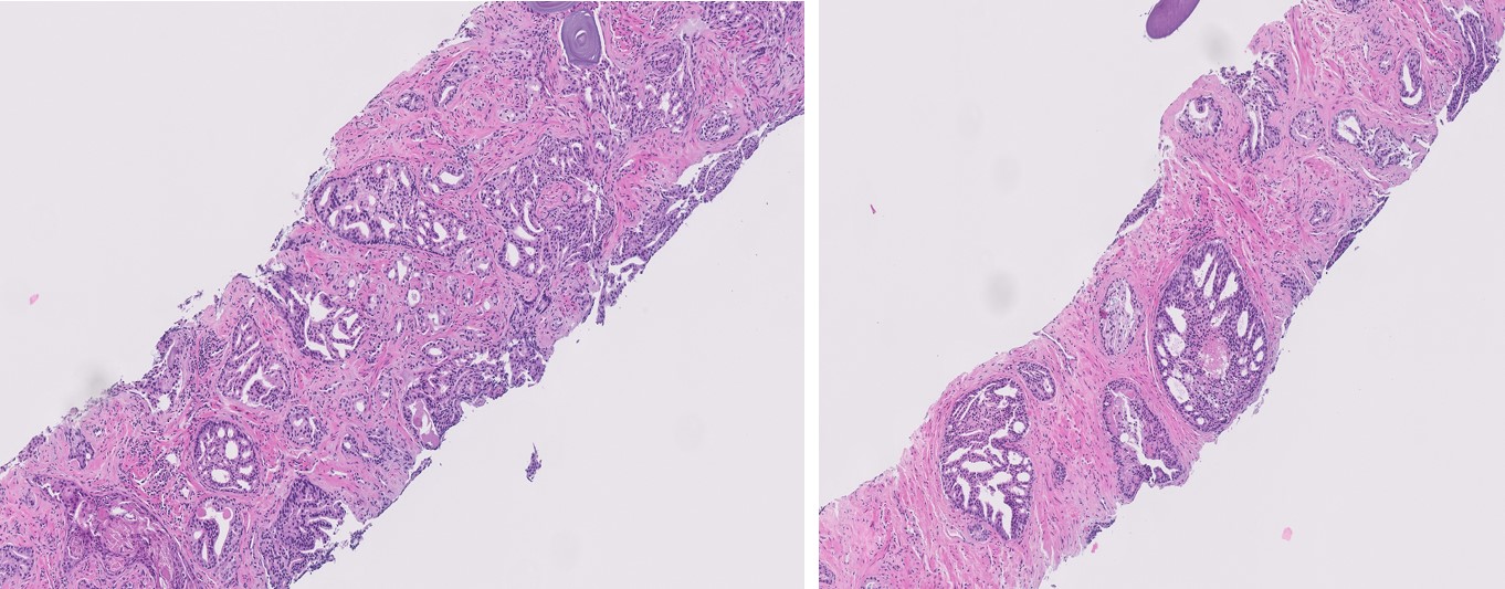 Microscopic image possibly detecting cancerous areas in human tissue