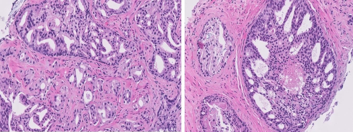 Microscopic image possibly detecting cancerous areas in human tissue