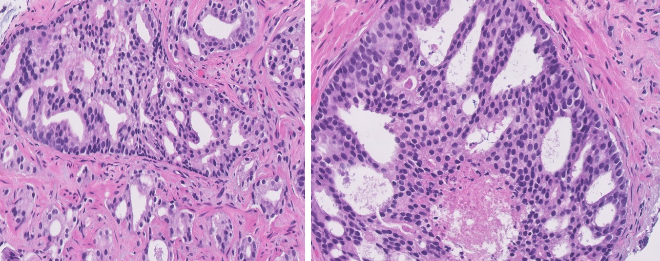 Microscopic image possibly detecting cancerous areas in human tissue