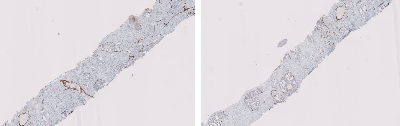 Microscopic image possibly detecting cancerous areas in human tissue