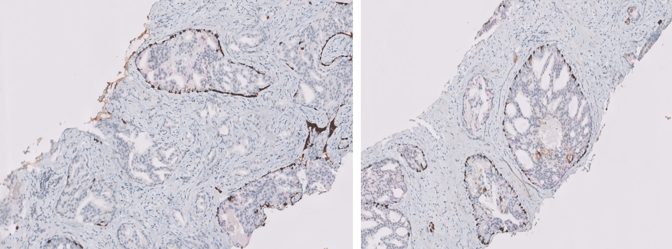 Microscopic image possibly detecting cancerous areas in human tissue