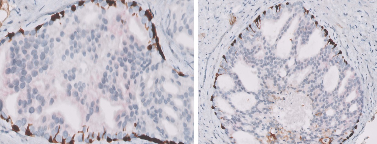 Microscopic image possibly detecting cancerous areas in human tissue