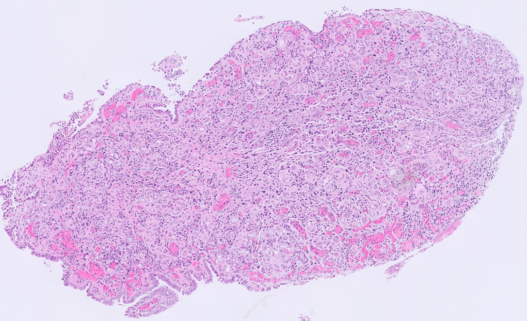 Microscopic image possibly detecting cancerous areas in human tissue