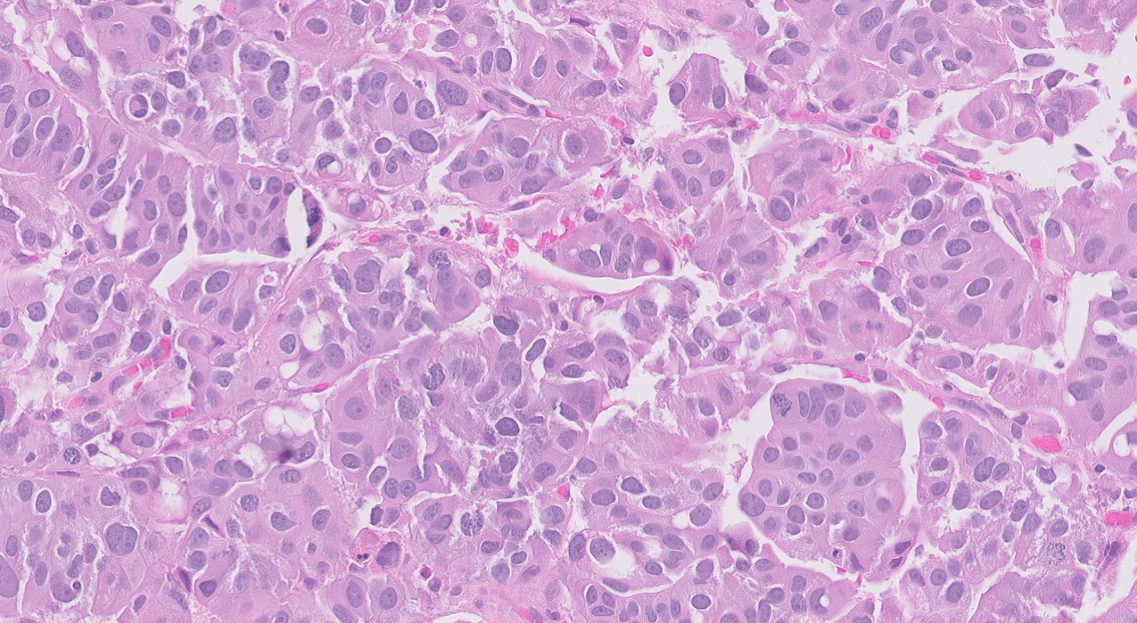 Microscopic image possibly detecting cancerous areas in human tissue