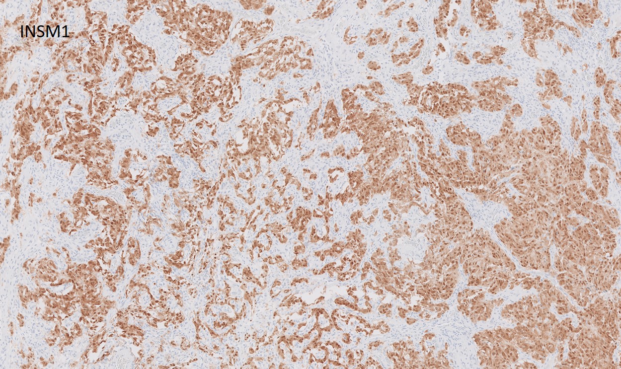 Microscopic image possibly detecting cancerous areas in human tissue