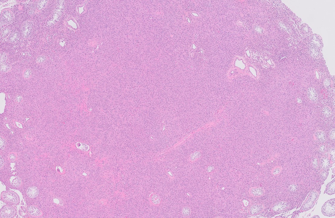 Microscopic image possibly detecting cancerous areas in human tissue