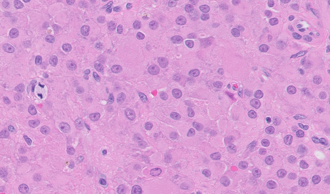 Microscopic image possibly detecting cancerous areas in human tissue