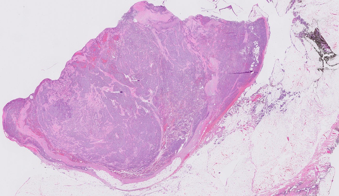 Microscopic image possibly detecting cancerous areas in human tissue